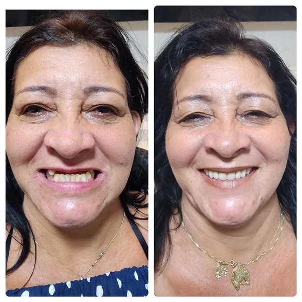 Antes e depois de implante dentário na OdontoLight