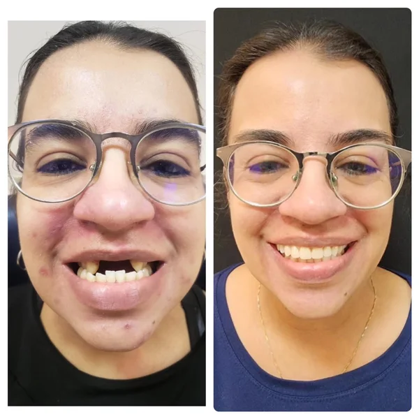 Fernanda, antes e depois do implante dentário na OdontoLight