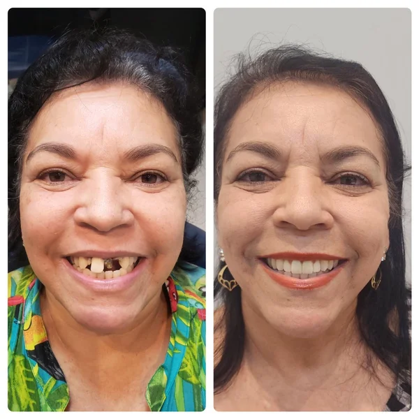 Dona Neide, antes e depois do implante dentário na OdontoLight