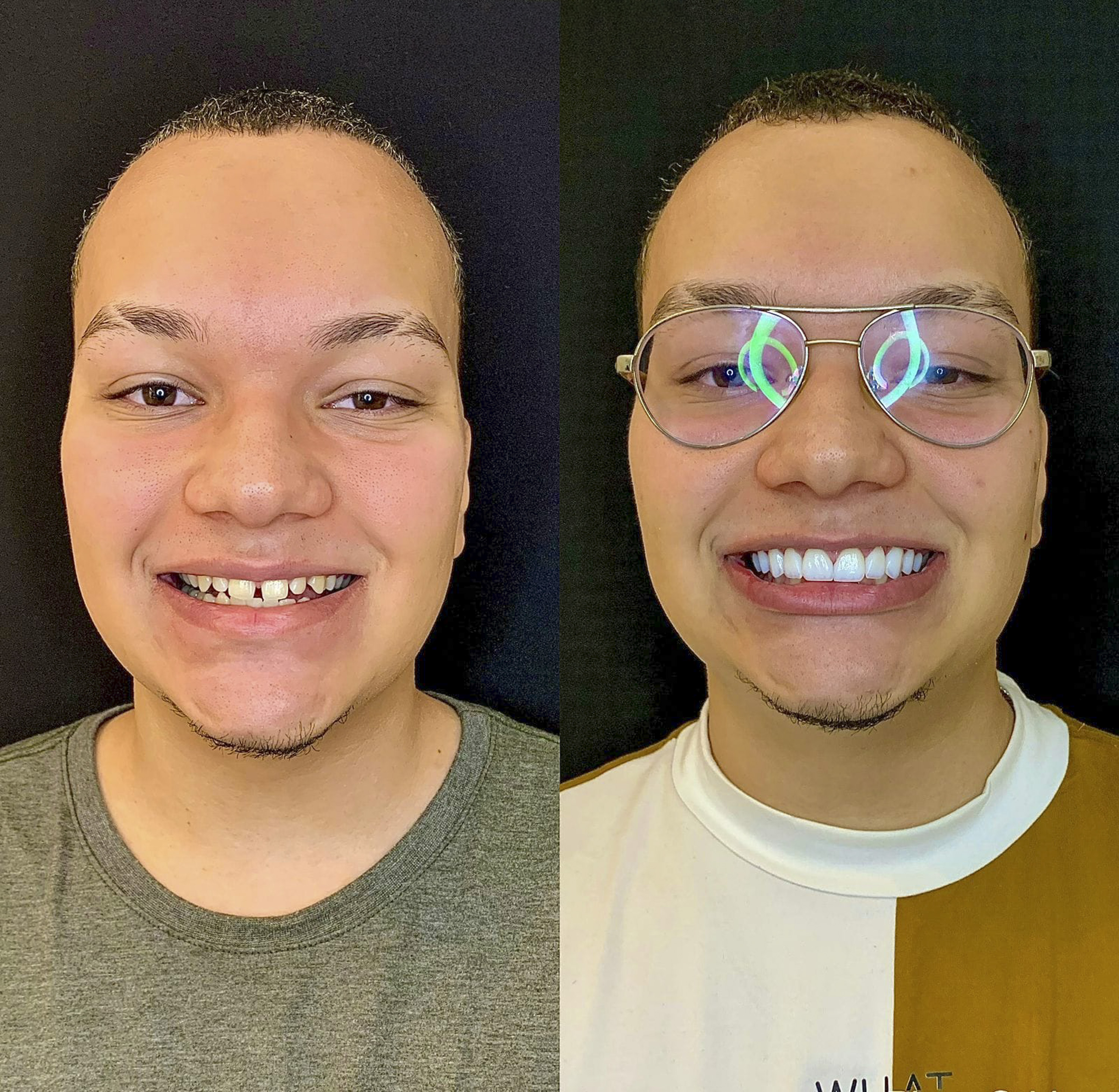 Antes e depois de lentes de contato dental na OdontoLight