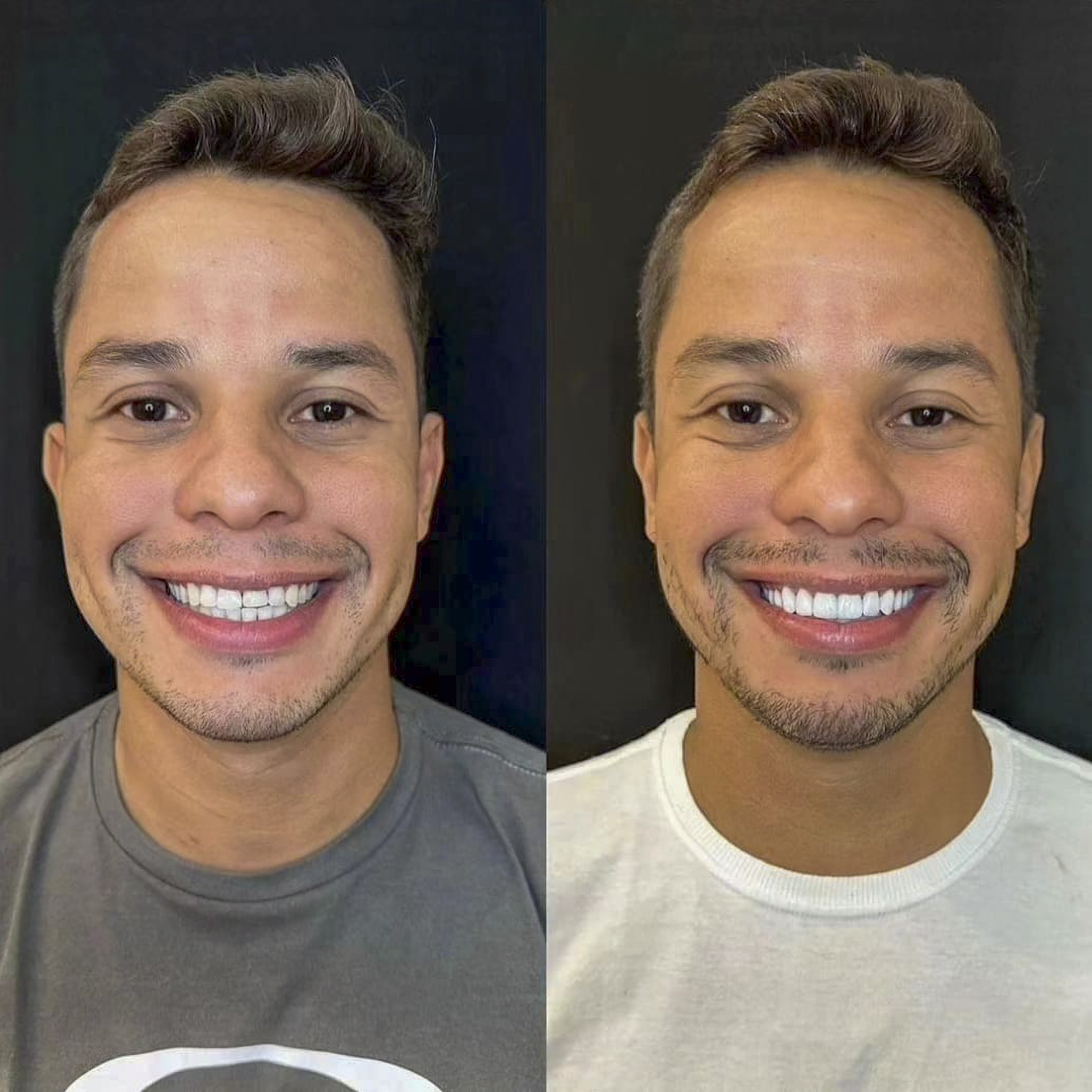 Antes e depois de lentes de contato dental na OdontoLight