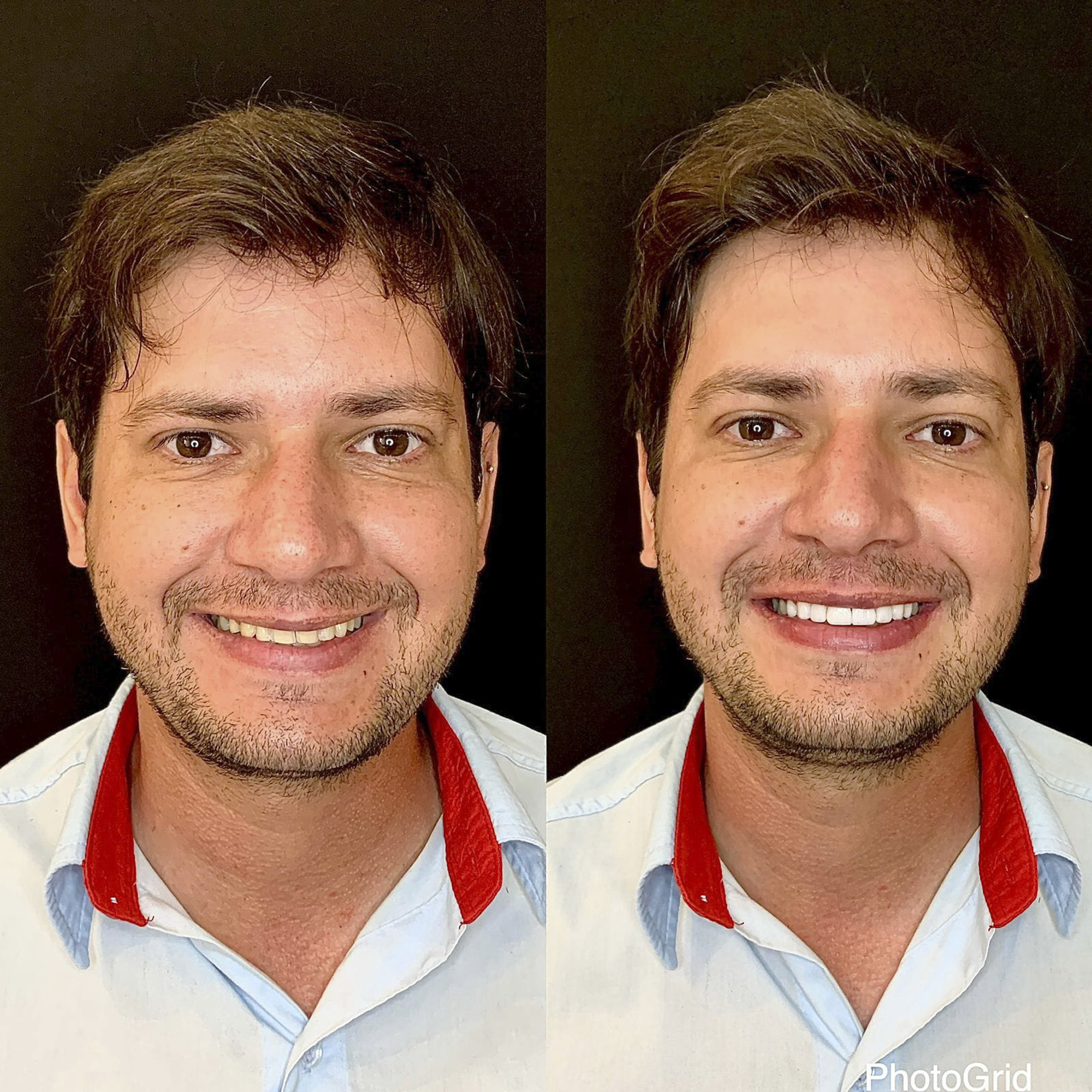 Antes e depois de lentes de contato dental na OdontoLight