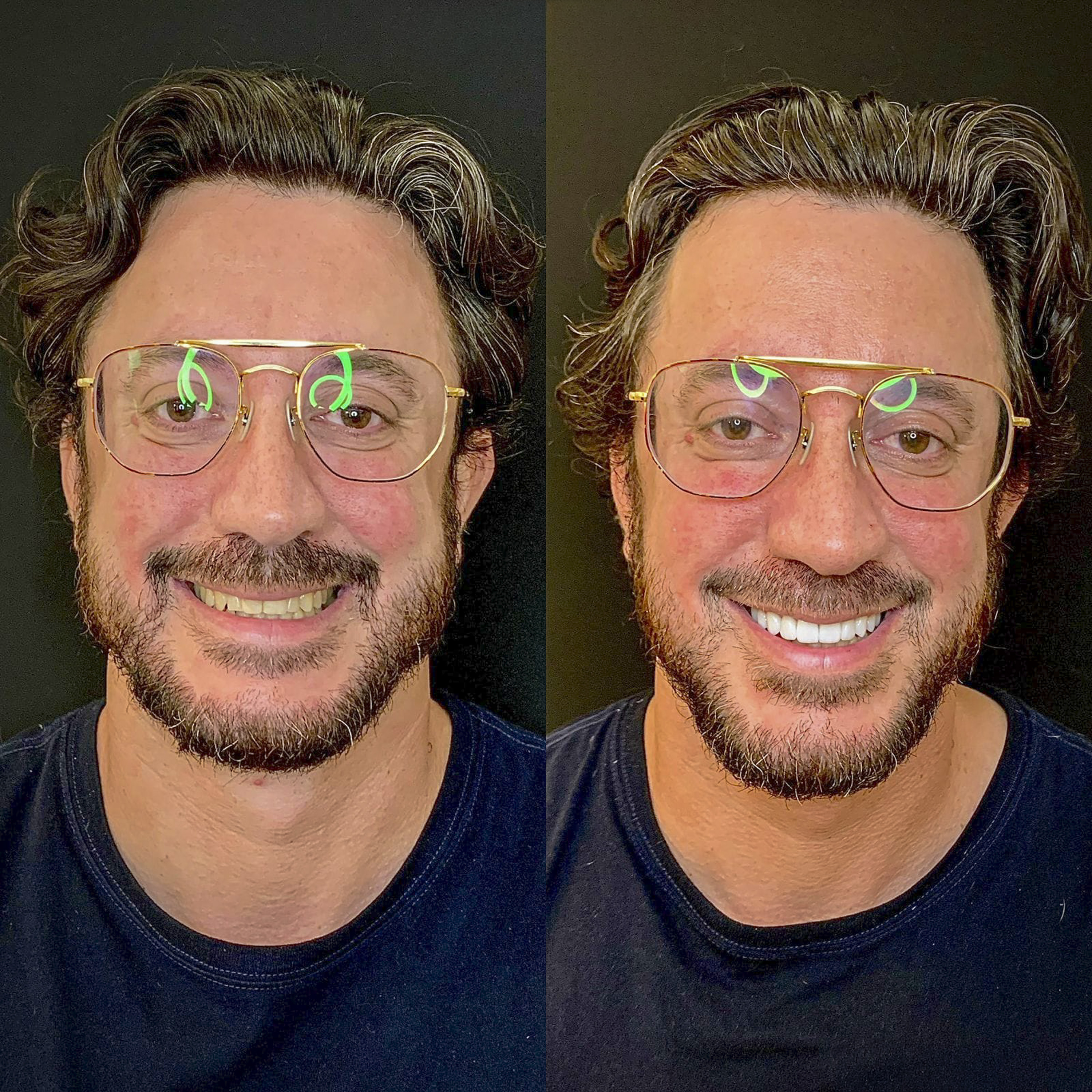 Antes e depois de lentes de contato dental na OdontoLight