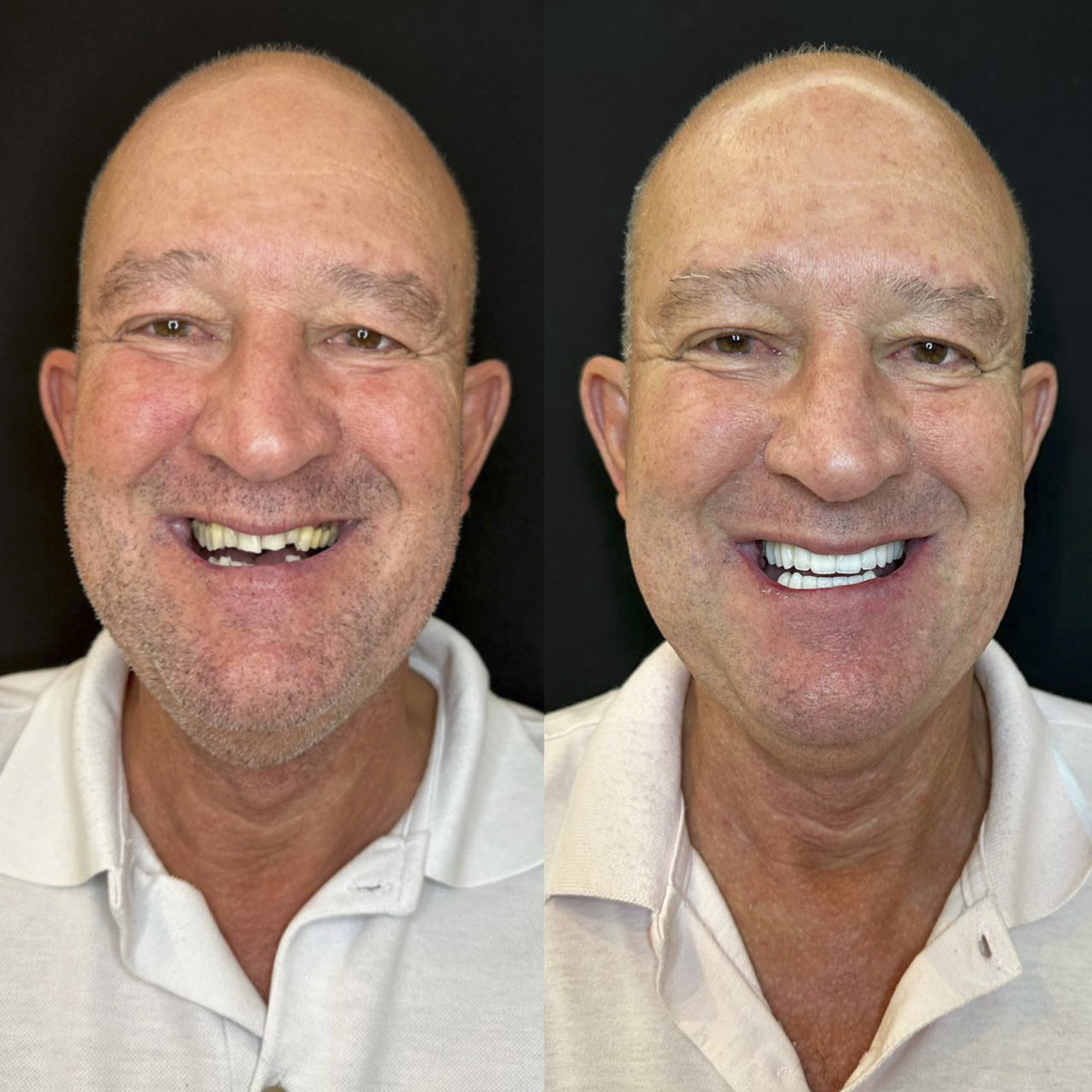 Antes e depois de lentes de contato dental na OdontoLight