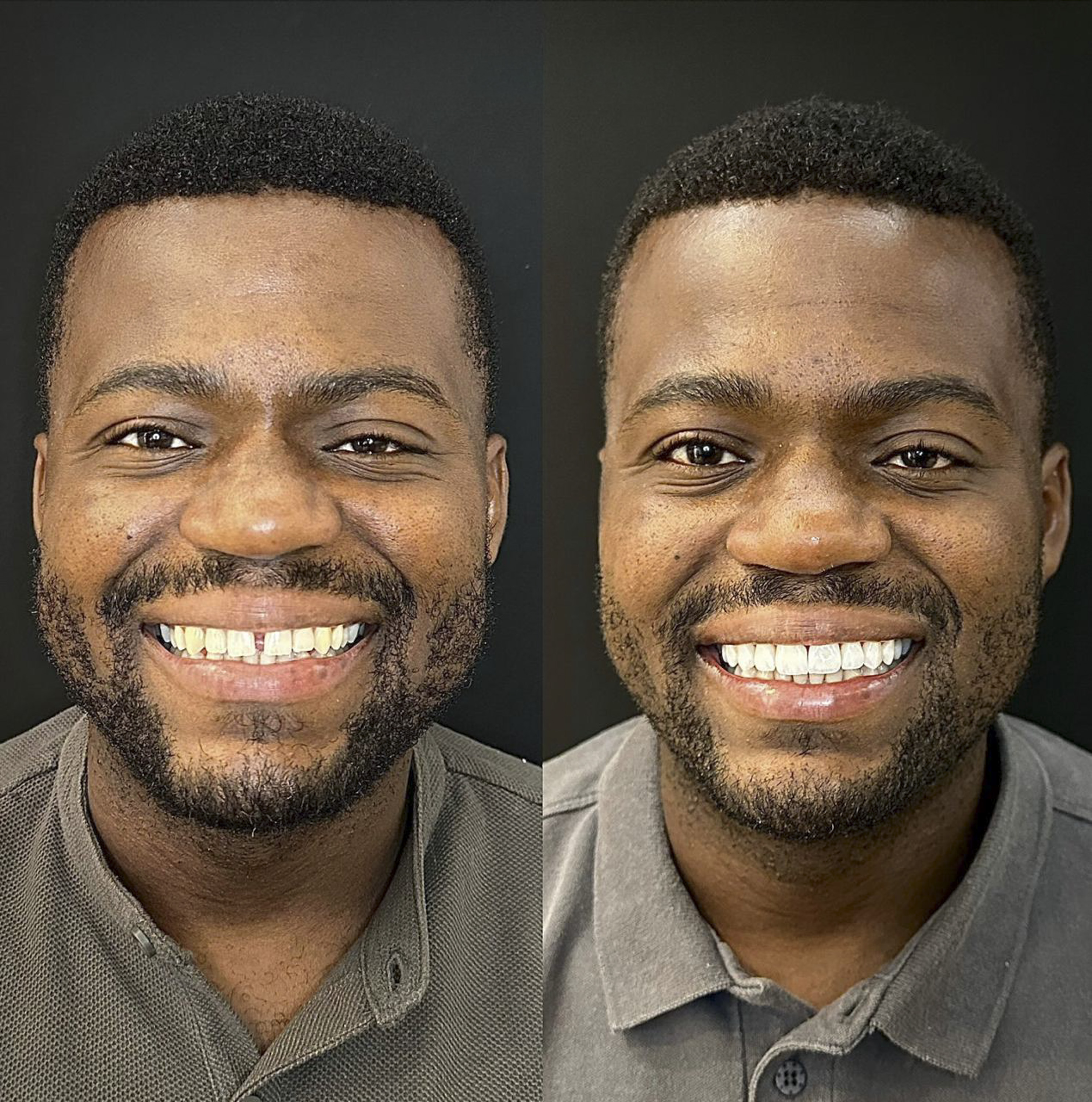 Lucas, antes e depois das lentes de contato dental na OdontoLight